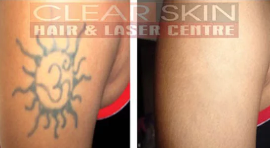 What Are the Ways to Remove Tattoos? 3 Tattoo Removal Options You Have -  Night Helper